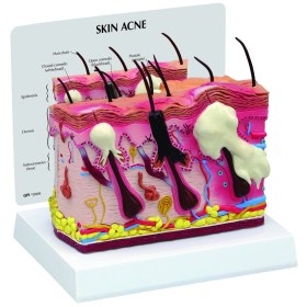 Skin Acne  Model 1019568