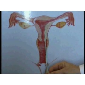 Καθετήρας λήψης ενδομητρικού υγρού Rampipella - 