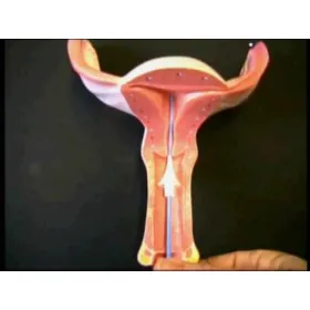 Sonohysterography uterine catheters MINIJECTOR CM 5fr - 