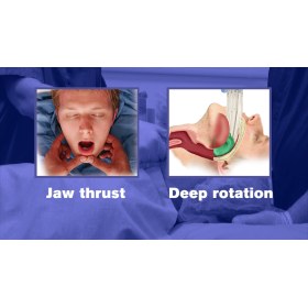 I-GEL Supraglottic Airway | No 4 Medium Adult  - 