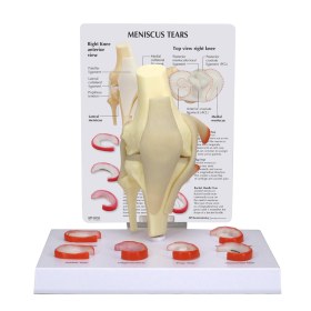 Meniscus Knee Model with 6 Tears 1019500