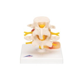 Human Lumbar Spinal Column with Prolapsed Intervertebral Disc A76