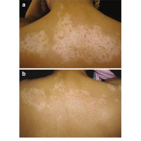 Phototherapy device for Dermatological deseases KERNEL 4003 BL