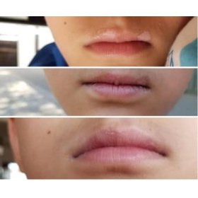 Phototherapy device for Dermatological deseases KERNEL 4003 BL