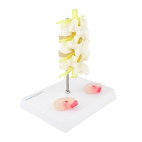 Lumbar Spine Model with Herniated Disc 139061 - 