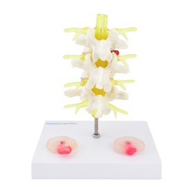 Πρόπλασμα οσφυϊκής μοίρας σπονδυλικής στήλης 139061