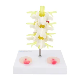Lumbar Spine Model with Herniated Disc 139061
