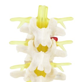 Lumbar Spine Model with Herniated Disc 139061 - 