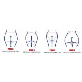 Μηχάνημα αδυνατίσματος και αύξησης μυϊκής μάζας EMS Sculpt