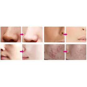 Diamond Microdermabrasion Instrument LB039