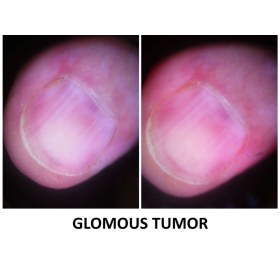 Συσκευή δερματοσκόπησης νυχιών και καπιλαροσκόπησης DermLite Nailio®