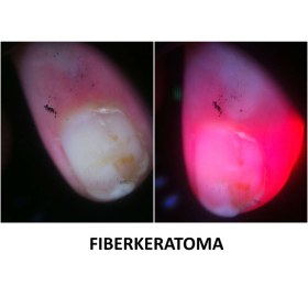 Συσκευή δερματοσκόπησης νυχιών και καπιλαροσκόπησης DermLite Nailio®