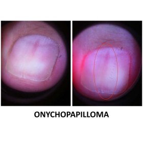 Συσκευή δερματοσκόπησης νυχιών και καπιλαροσκόπησης DermLite Nailio®