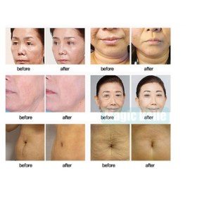 Συσκευή σύσφιξης και Lifting προσώπου-σώματος  με Ραδιοσυχνότητες Thermolift Focus RF 