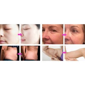 JF656 Portable 6 in 1 Lipolaser Cavitation Vacuum RF Slimming Machine