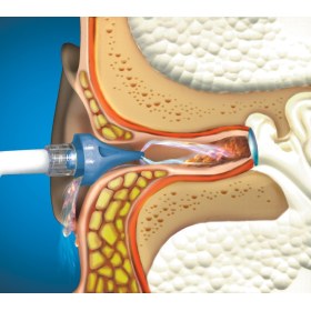 OtoClear® Ear Irrigation Tips with Gentle TouchTM Design