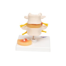 Πρόπλασμα μεσοσπονδύλιων δίσκων με δισκοκήλη A76