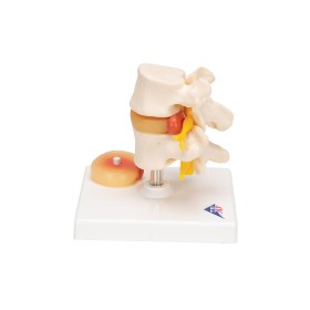 Πρόπλασμα μεσοσπονδύλιων δίσκων με δισκοκήλη A76