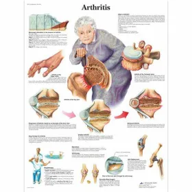 Arthritis poster