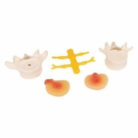 Πρόπλασμα μεσοσπονδύλιων δίσκων με δισκοκήλη A76