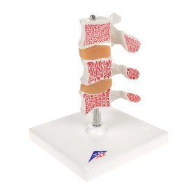 Deluxe Osteoporosis Model (3 Vertebrae) Α78