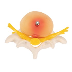 Πρόπλασμα μεσοσπονδύλιων δίσκων με δισκοκήλη A76