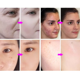 7-Colors Tri-Folding LED Light Therapy Machine