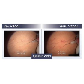 Διοφθάλμιες λούπες αισθητικών εφαρμογών 3Gen Syris v900L Visualization System