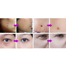 Mesotherapy gun MESOGUN SC470