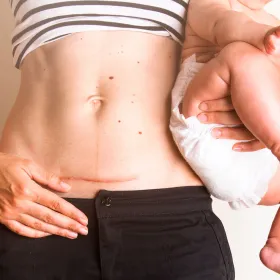 Gel σιλικόνης επούλωσης ουλών REVEE SCAR GEL 20gr