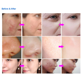 Microdermabrasion device with diamond LB592B digital