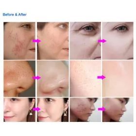 Microdermabrasion device with diamond LB592B digital