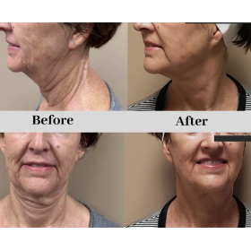 Συσκευή μεσοθεραπείας fractional RF BY206