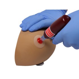 Πρόπλασμα ενδοοστικής έγχυσης χεριού AMY 7780