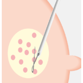 Σύρμα εντοπισμού μαστού 0IM2010 20G x 10cm