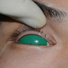 Silicone eye covers for blepharoplasty procedures 6 pieces