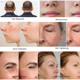 Συσκευή αισθητικής FUSION PLASMA για περιποίηση δέρματος και τριχωτού της κεφαλής - 