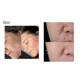 Diode Laser Alpha3 with 3 wavelengths   800W 755,808,1064nm