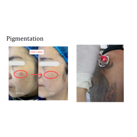 Diode Laser Alpha3 with 3 wavelengths   800W 755,808,1064nm