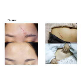 Diode Laser Alpha3 with 3 wavelengths   800W 755,808,1064nm