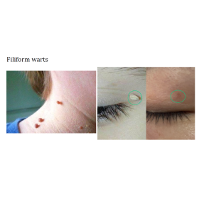 Diode Laser Alpha3 with 3 wavelengths   800W 755,808,1064nm