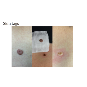 Diode Laser Alpha3 with 3 wavelengths   800W 755,808,1064nm