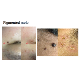 Diode Laser Alpha3 with 3 wavelengths   800W 755,808,1064nm