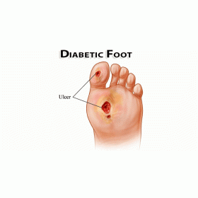 Diabetic Foot