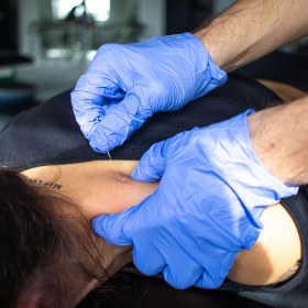 Acupuncture Needles with Guide Tube 100 pieces Yellow Sport - 